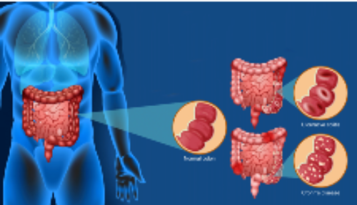 Conociendo los mecanismos moleculares de una bacteria potencialmente benéfica para colitis ulcerosa y enfermedad de Crohn