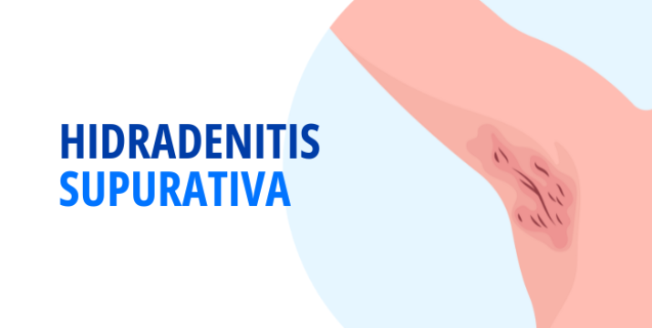 Hidradenitis supurativa: The Lancet publica artículo con destacada participación chilena