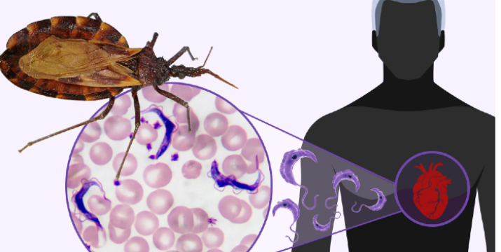 Identifican biomarcadores para predecir el daño cardíaco en la enfermedad de Chagas