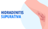 Hidradenitis supurativa: The Lancet publica artículo con destacada participación chilena